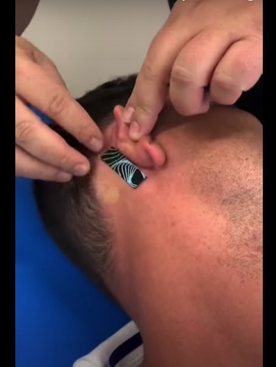 You are currently viewing Inhibition of the aberrant myotatic reflex of the hip when applying Magnetic Tape on scar behind ear